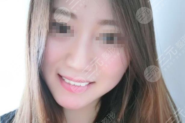 北京佳美口腔医院牙齿美白案例分享