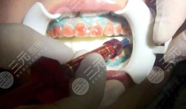 北京佳美口腔医院牙齿美白案例分享