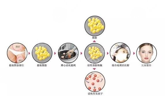 脂肪填充多久恢复