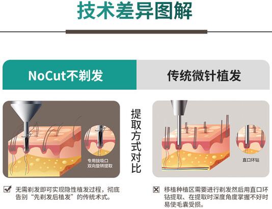 国内植发专家科普手术知识