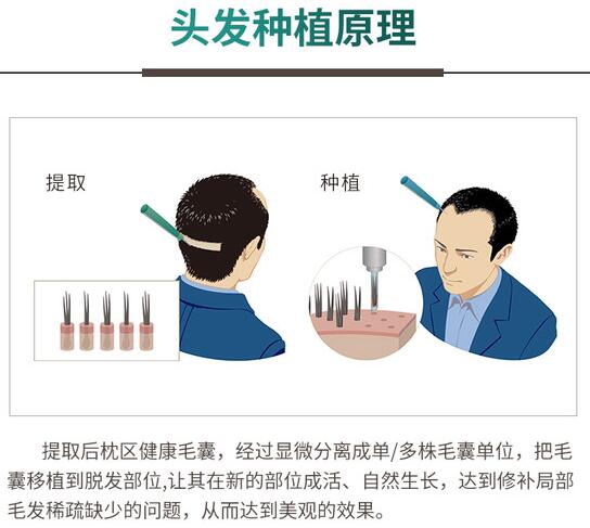 国内植发专家科普手术知识