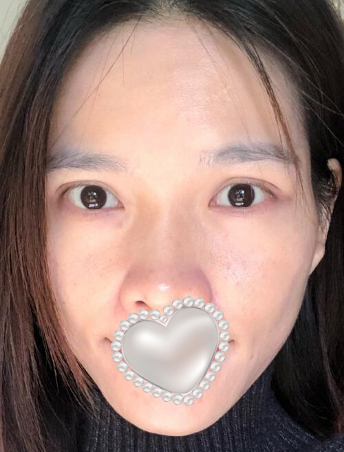 光子嫩肤体验果图