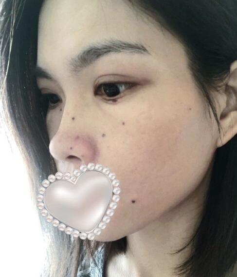 光子嫩肤体验果图