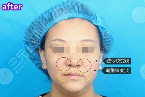 pst面部抗衰术后