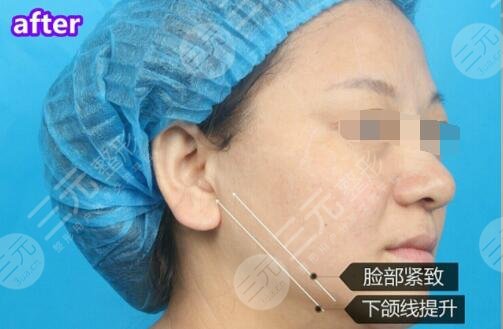 pst面部抗衰果