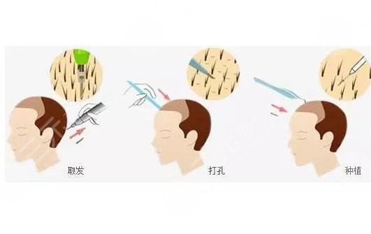 大连大麦微针植发医院头发种植相关介绍