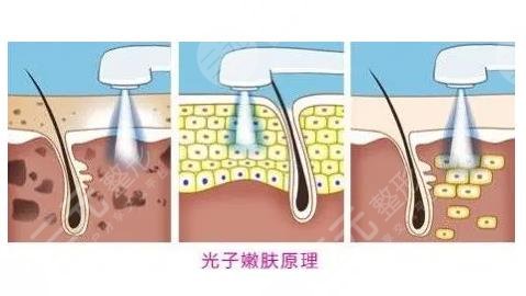 光子嫩肤后注意事项有哪些