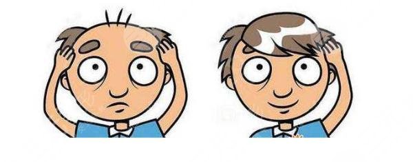 微创植发注意事项