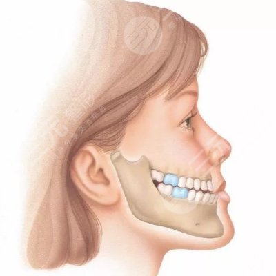 如果是因为单纯的牙齿错颌产生的地包天,上下颌骨发育也比较正常,此类