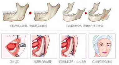 磨骨过程