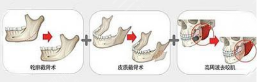 磨骨经过