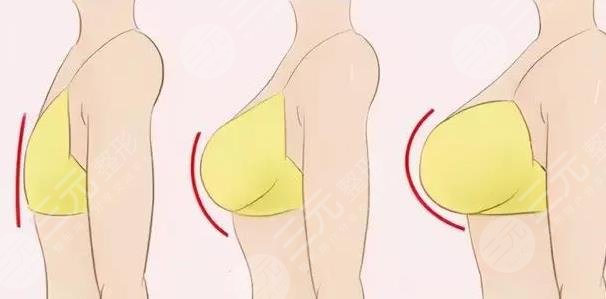 隆胸手术相关介绍