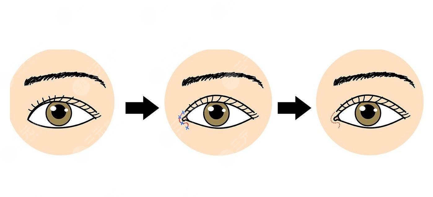 韩勋开眼角疤痕重吗