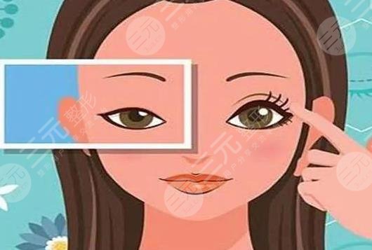 开眼角项目相关介绍