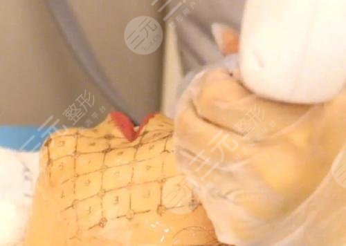 做完热玛吉多长时间有明X的果?