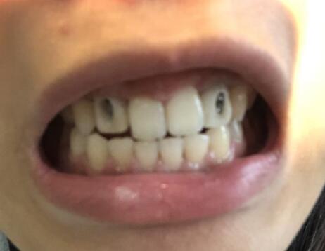 种植牙果图参考