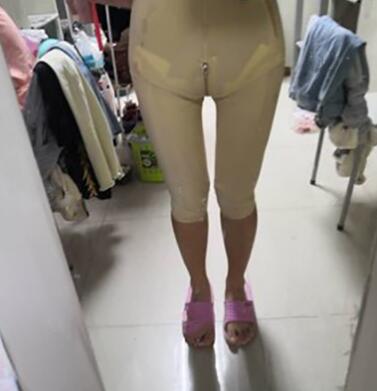 以色列钻石大腿吸脂案例