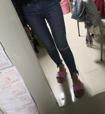 以色列钻石大腿吸脂案例