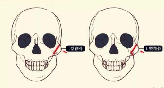 国内磨骨多少钱