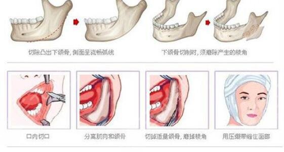 磨下颌角