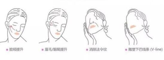 少女轮廓线手术注意事项