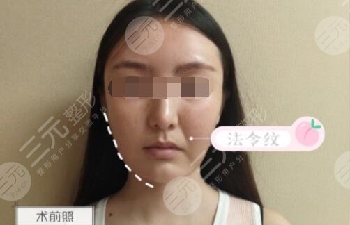 少女轮廓线整形案例前