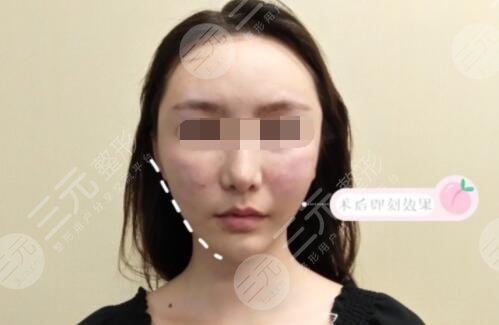 少女轮廓线整形案例后