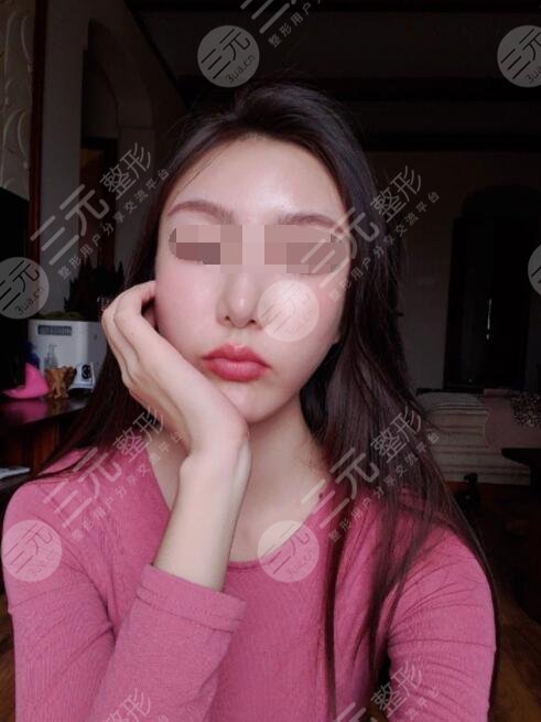 少女轮廓线整形案例后果