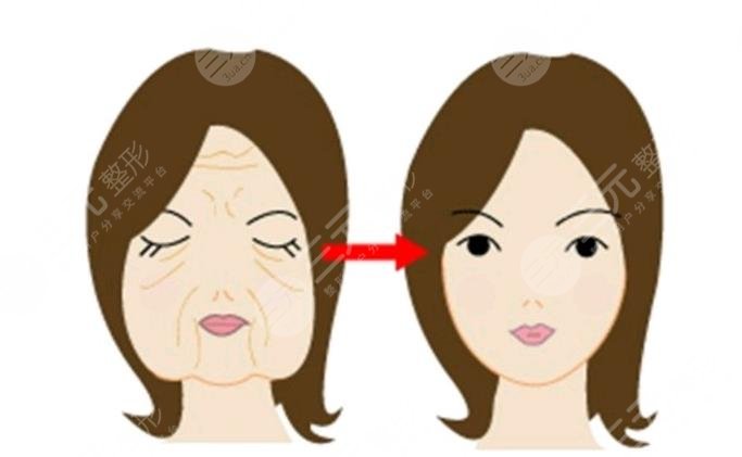 上海九院热玛吉相关科普