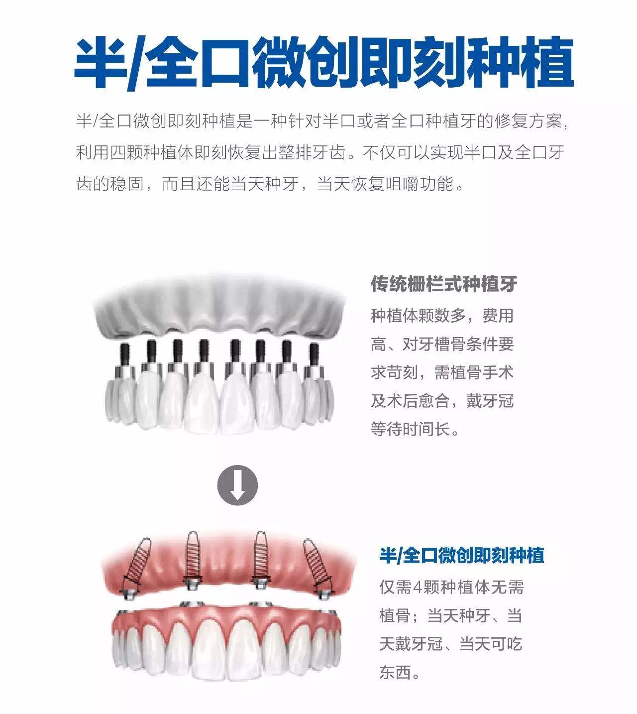 北京中诺口腔医院科普种植牙