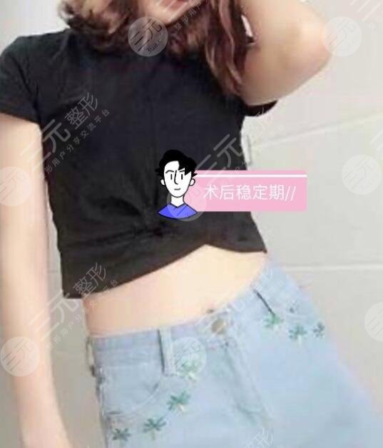 酷塑冷冻瘦腰术后果