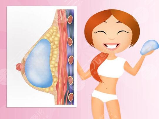 麦格假体可以长期在体内吗