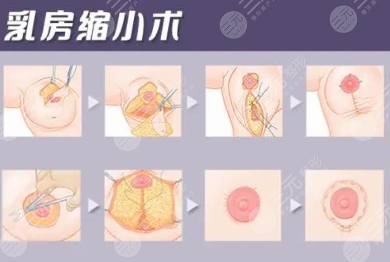 乳房缩小手术原理