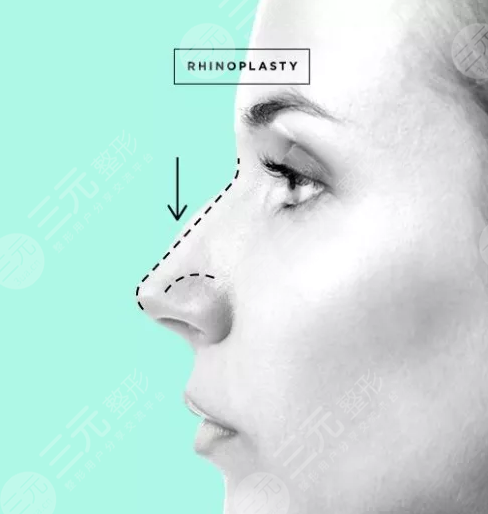 肥厚鼻尖矫正术