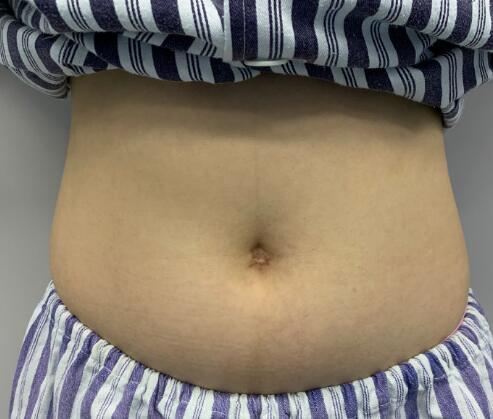 抽脂肪肚子多少钱一次?想塑造窈窕腰腹,价格攻略分享!