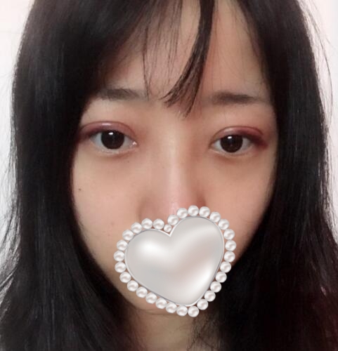 三点定位双眼皮果图分享