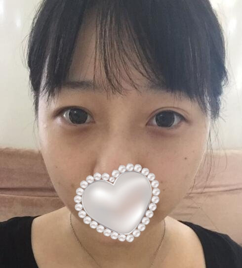 三点定位双眼皮果图分享