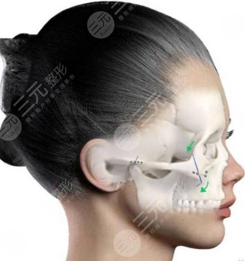 下颌角磨骨脸会下垂么？下颌角手术风险及注意事项你可了解清楚了？
