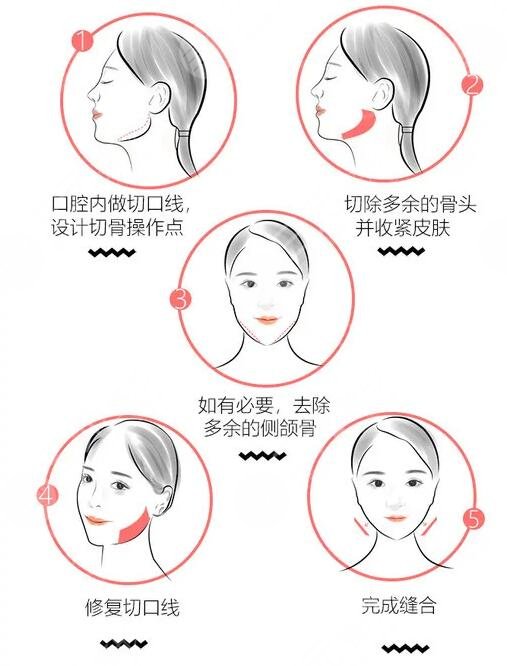 下颌角磨骨脸会下垂么