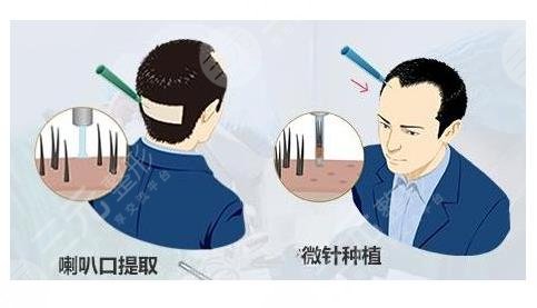 兰州植发医院发际线种植相关问题介绍