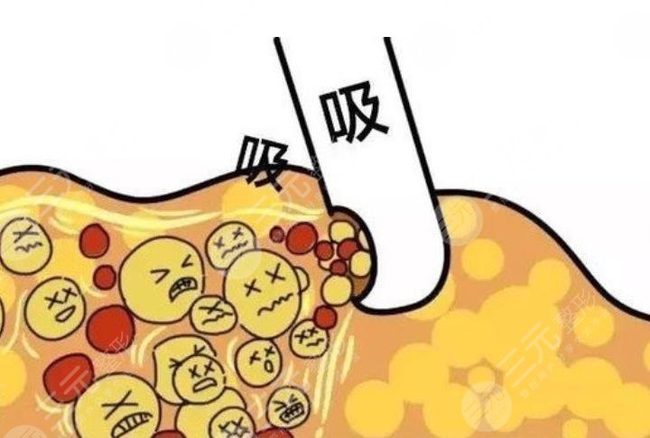 瘦身栏目|超脂塑吸脂有没有副作用?来看看哪些人不适合做!
