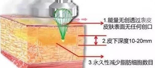 超脂塑术后恢复期是多久?