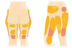 整容腿部吸脂多少钱？美腿塑形价格表2021新分享，攻略帮你搞定了！