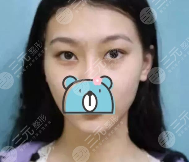 西京医院整形科双眼皮案例