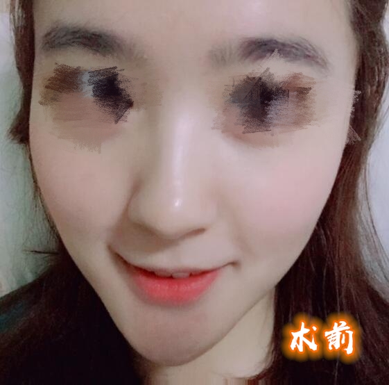假体隆鼻果图分享