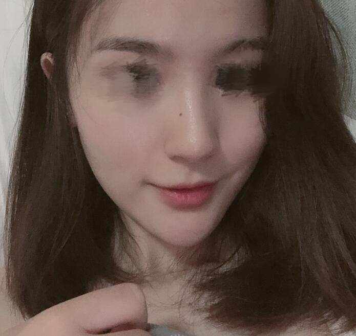 假体隆鼻果图分享