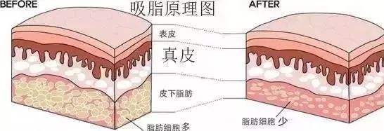 腹部吸脂