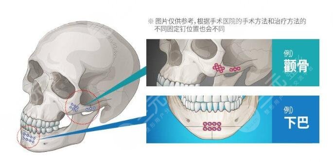 手术注意事项