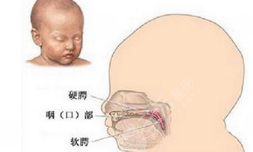 唇腭裂修复手术大概需要多少费用？价格主要看这几点...