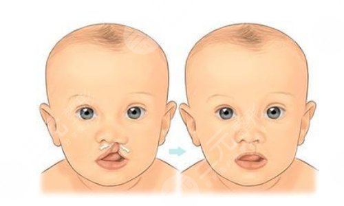 唇腭裂修复手术费用价格影响因素